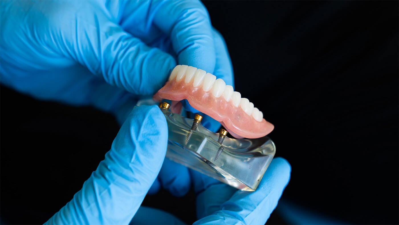 Bar Attachment Denture | Summit Oral Surgery & Implant Center